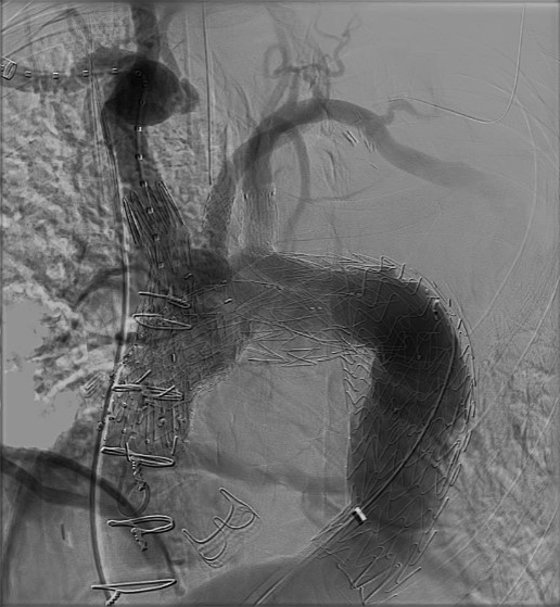 Total aortic arch repair closeup